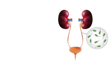 Urinary Tract Infection (UTI) illustration showing the urinary system and bacteria for UTI treatment in Pune by Dr. Kalpesh Saswade at Vandana Uro Care.