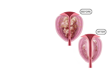 Before and after Rezum Therapy for enlarged prostate (BPH) showing reduction in prostate tissue by Dr. Kalpesh Saswade at Vandana Uro Care in Pune.